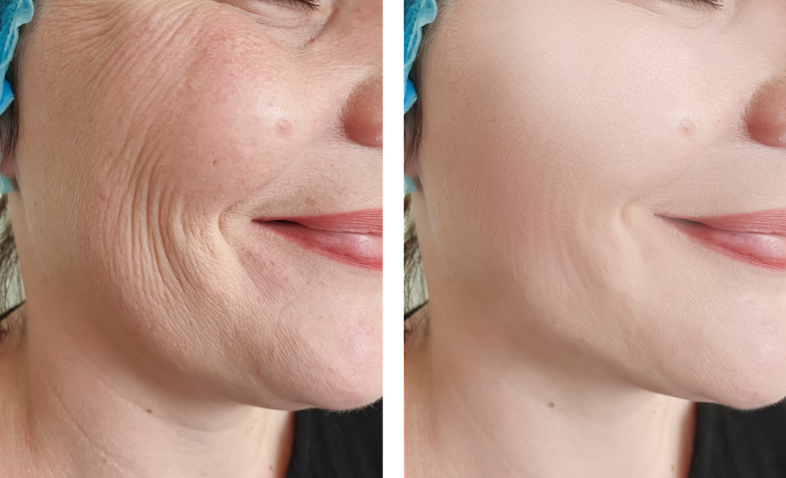 woman wrinkles before and after procedures