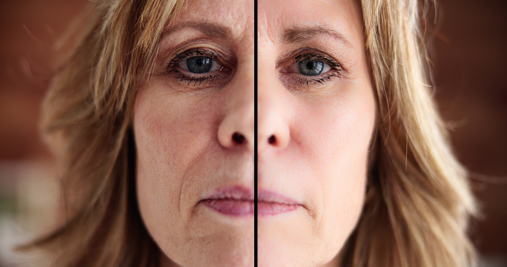 Woman Before After Skin Lift Dermatology